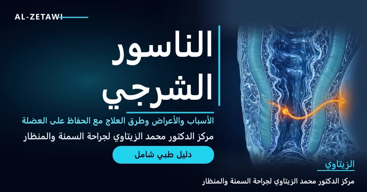 رسم طبي ثلاثي الأبعاد لمقطع في القناة الشرجية والعضلة العاصرة يظهر فيه مسار الناسور مضيئًا باللون البرتقالي — الناسور الشرجي | د. محمد عبد الوهاب الزيتاوي