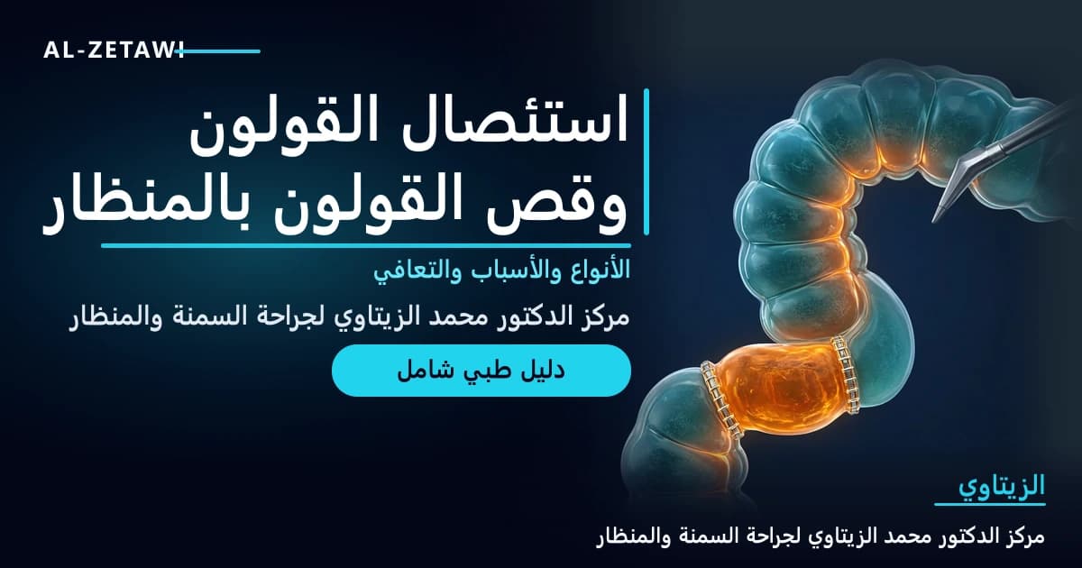 رسم طبي ثلاثي الأبعاد لقولون شفاف بلون فيروزي مع جزء من القولون السيني متوهج بالبرتقالي بين خطي دباسة جراحية وأداة منظار — استئصال القولون وقص القولون بالمنظار | د. محمد عبد الوهاب الزيتاوي