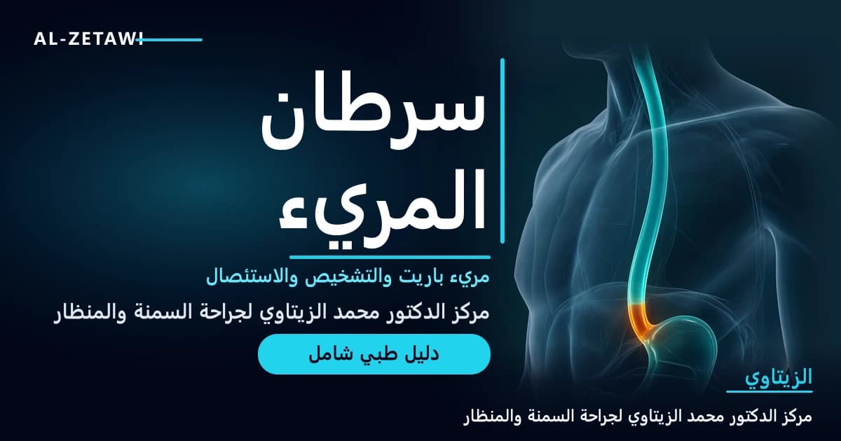 رسم طبي ثلاثي الأبعاد لمريء شفاف يمتد من الحلق إلى المعدة مع جزء متوهج متضيق قرب نهايته السفلية — سرطان المريء | د. محمد عبد الوهاب الزيتاوي