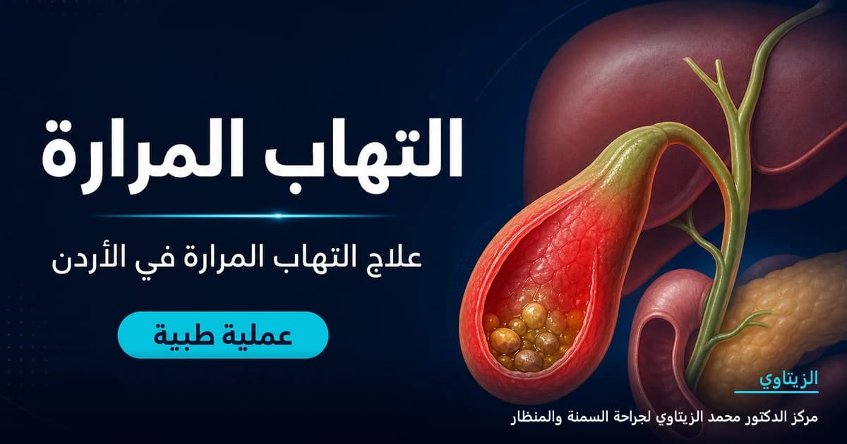 التهاب المرارة | د. محمد عبد الوهاب الزيتاوي التهاب المرارة — رسم توضيحي للعملية في الأردن | د. محمد عبد الوهاب الزيتاوي