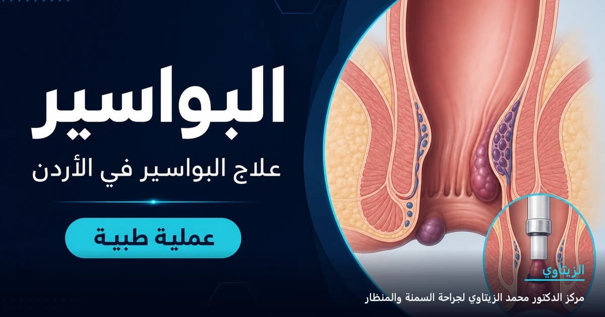 البواسير — رسم توضيحي للعملية في الأردن | د. محمد عبد الوهاب الزيتاوي