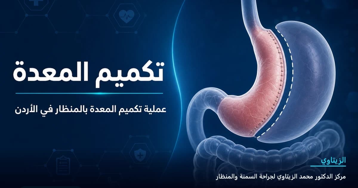 تكميم المعدة — رسم توضيحي للعملية في الأردن | د. محمد عبد الوهاب الزيتاوي