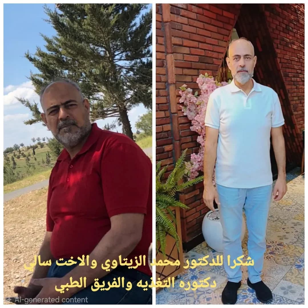 صورة قبل وبعد عملية تحويل المسار المصغر للمريض عدنان الدليمي من العراق: نزول من 147 إلى 86 كيلو — مركز الدكتور محمد عبد الوهاب الزيتاوي