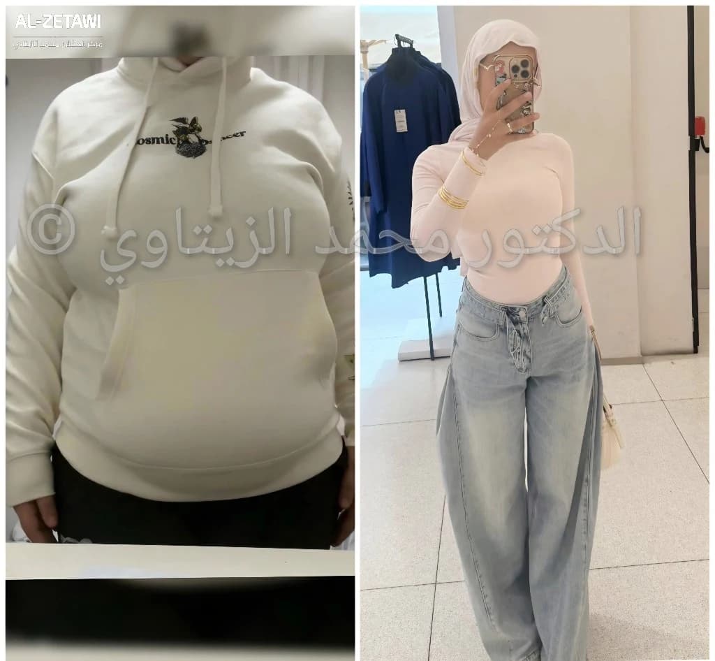 صورة قبل وبعد عملية تحويل المسار المصغر للشابة مجد من فلسطين: من 89 إلى 55 كيلو ومن مقاس XL إلى XS — مركز الدكتور محمد عبد الوهاب الزيتاوي