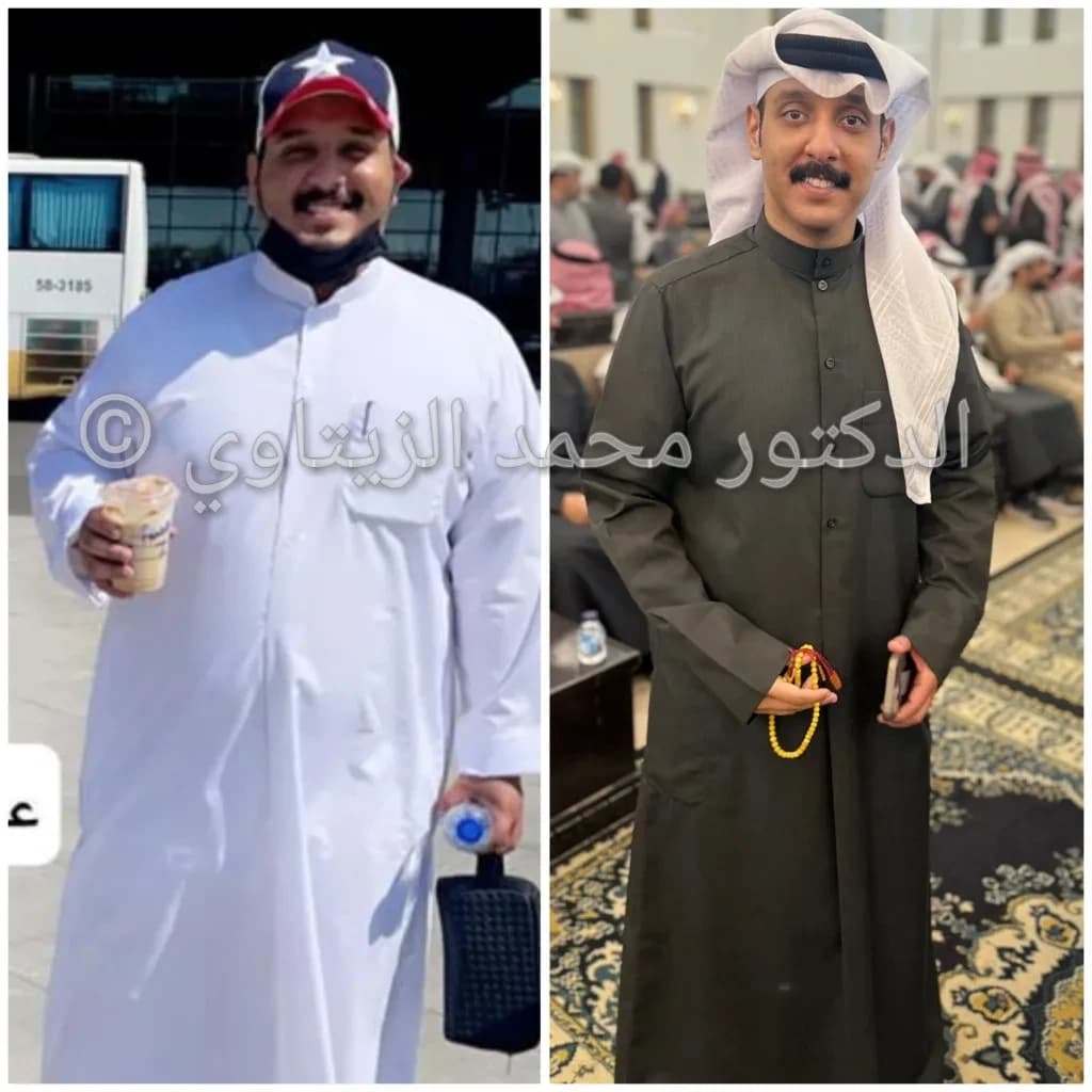 صورة قبل وبعد عملية تكميم المعدة للمريض أحمد الظفيري من الكويت: من 140 إلى 83 كيلو ومقاس الملابس من 3XL إلى L — مركز الدكتور محمد عبد الوهاب الزيتاوي