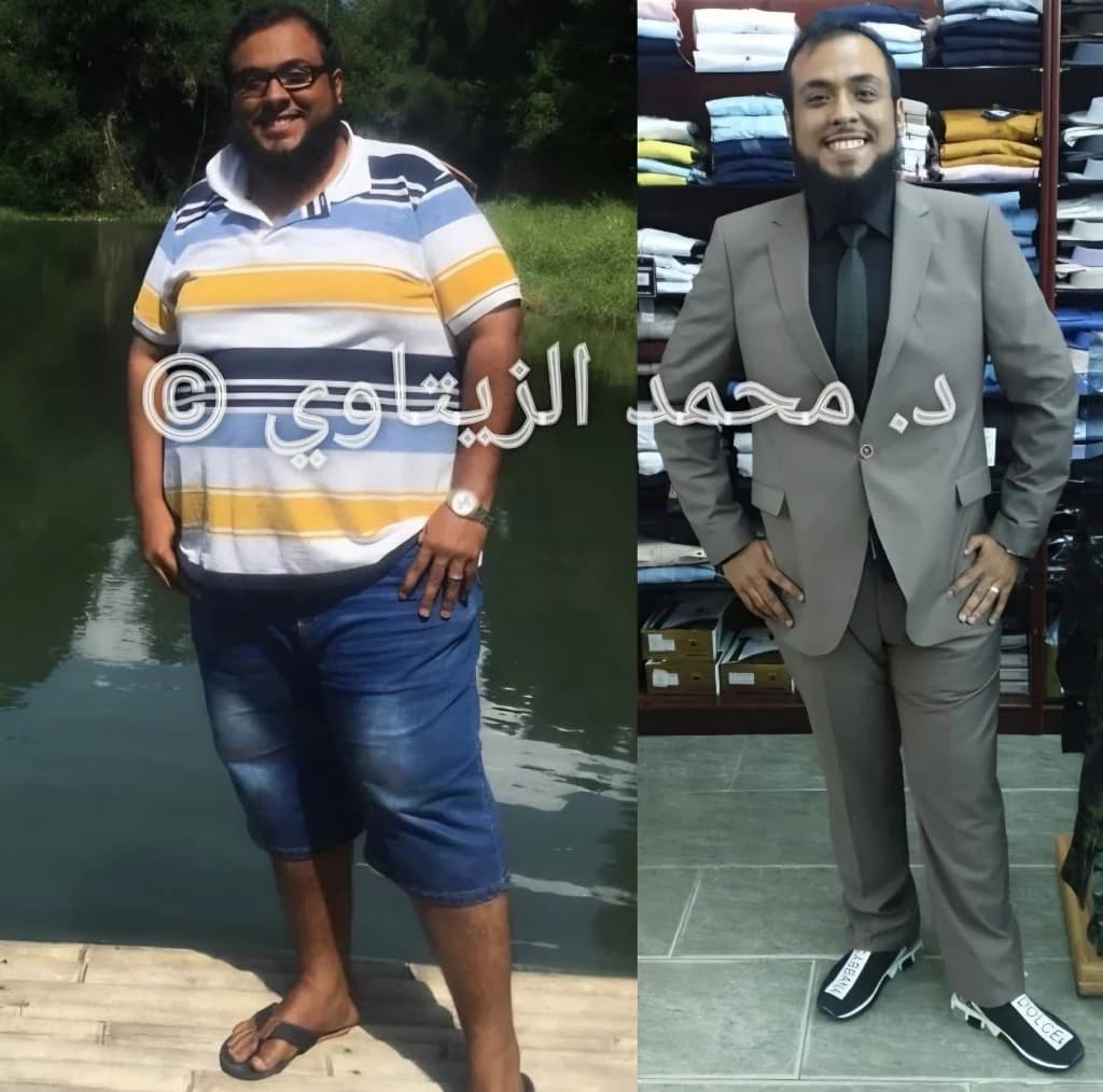 صورة قبل وبعد عملية تكميم المعدة لمحمد باجندوح من السعودية: من 150 إلى 87 كيلو بعد سنة من العملية — مركز الدكتور محمد عبد الوهاب الزيتاوي