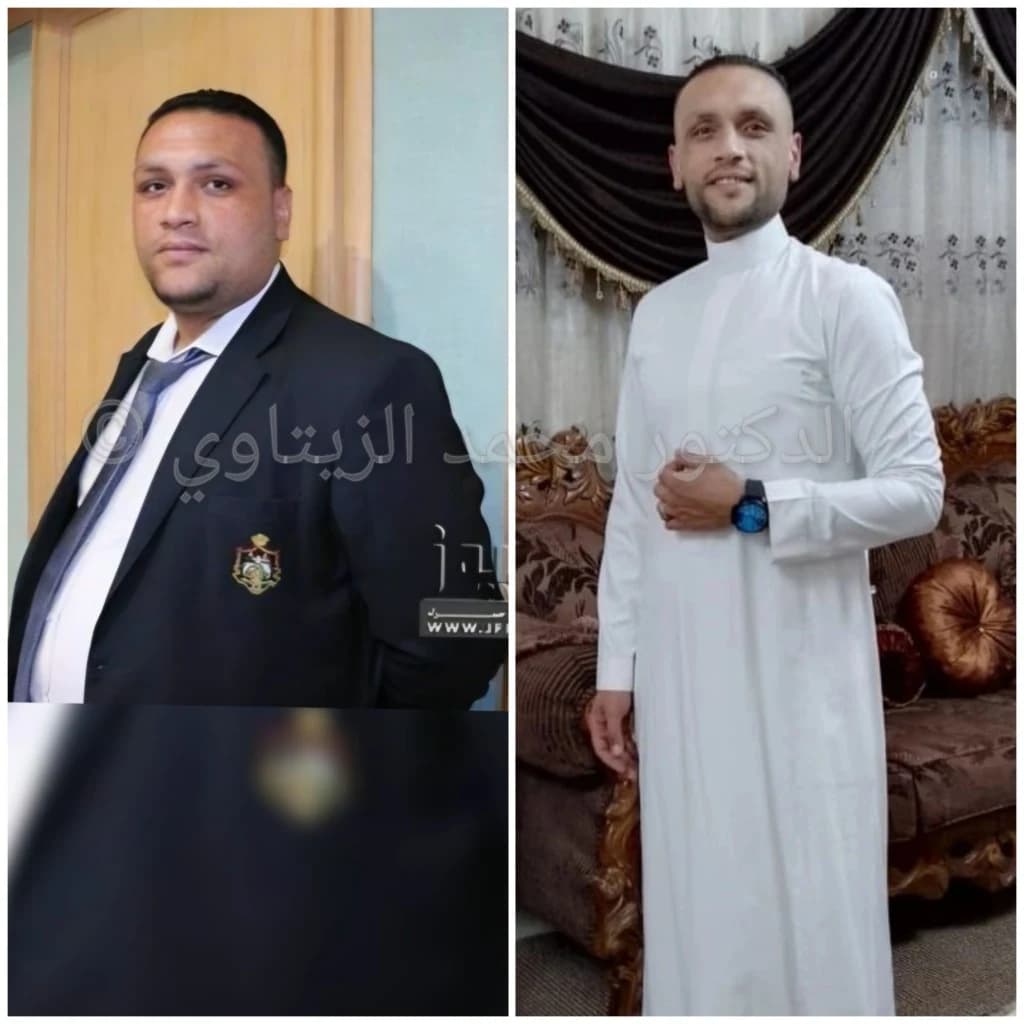 صورة قبل وبعد تكميم المعدة لمراد السيد من الأردن: من 178 كيلو إلى 90 كيلو، وما زال وزنه ثابتاً بعد 8 سنوات من العملية — مركز الدكتور محمد عبد الوهاب الزيتاوي