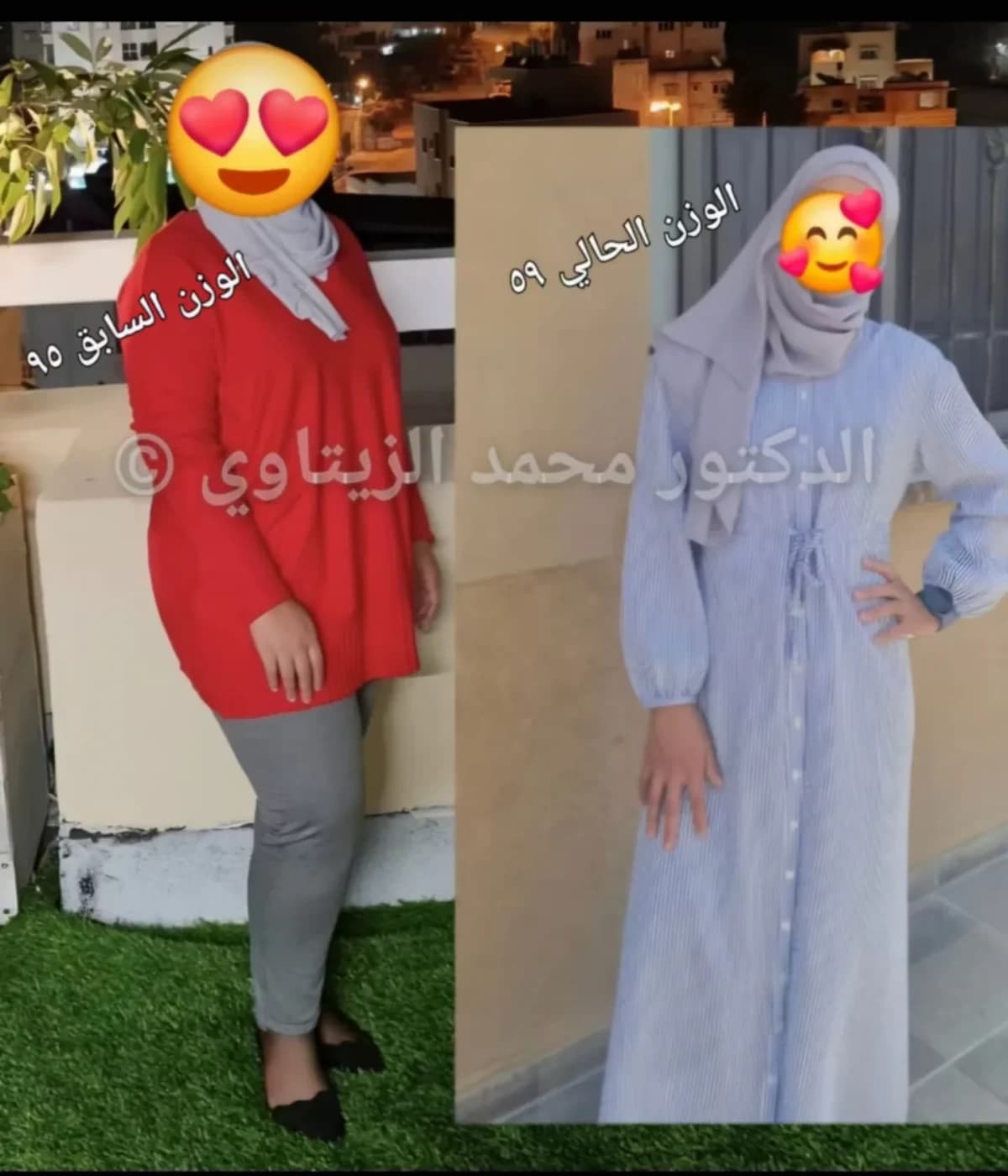 صورة قبل وبعد عملية تكميم المعدة للمريضة أماني من فلسطين: نزول من 95 إلى 59 كيلو — مركز الدكتور محمد عبد الوهاب الزيتاوي