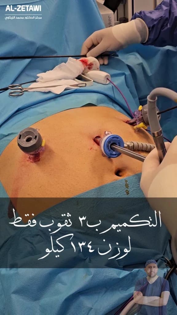 ثلاثة منافذ منظار فقط في بطن مريض وزنه 134 كيلو أثناء عملية تكميم المعدة — مركز الدكتور محمد عبد الوهاب الزيتاوي