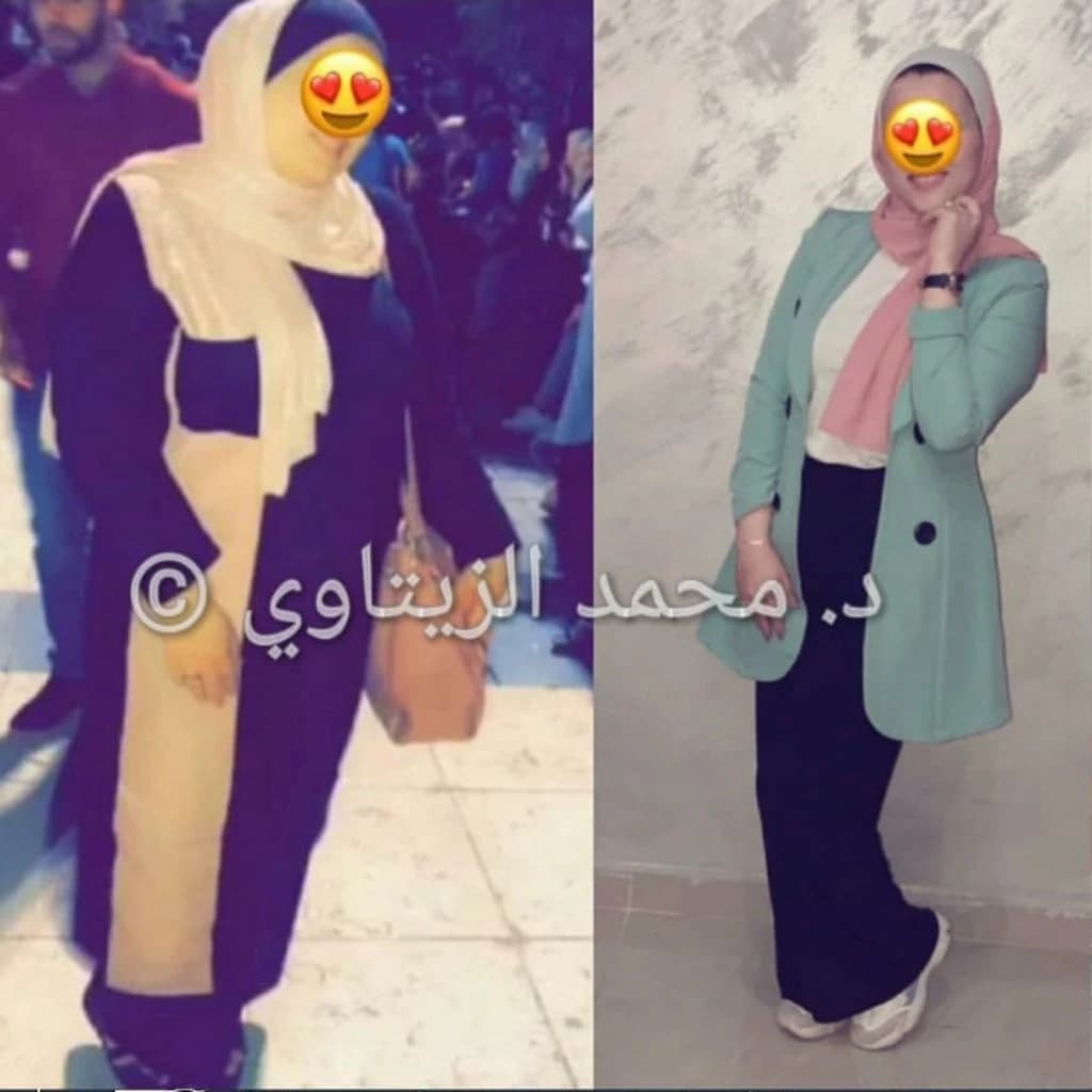 صورة قبل وبعد عملية تكميم المعدة للسيدة وئام عنانزة من الأردن: من 94 إلى 60 كيلو خلال أقل من سنة — مركز الدكتور محمد عبد الوهاب الزيتاوي