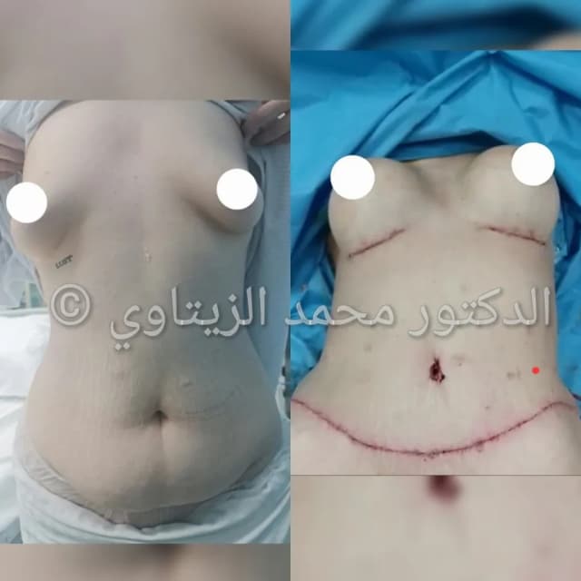 صورة قبل وبعد عملية شد البطن مع تكبير الصدر بحشوات السيليكون في الأردن: بطن مسطح وخصر منحوت وصدر متناسق — مركز الدكتور محمد عبد الوهاب الزيتاوي