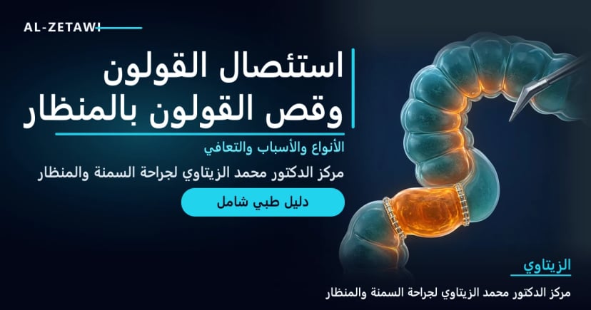 رسم طبي ثلاثي الأبعاد لقولون شفاف بلون فيروزي مع جزء من القولون السيني متوهج بالبرتقالي بين خطي دباسة جراحية وأداة منظار — استئصال القولون وقص القولون بالمنظار | د. محمد عبد الوهاب الزيتاوي
