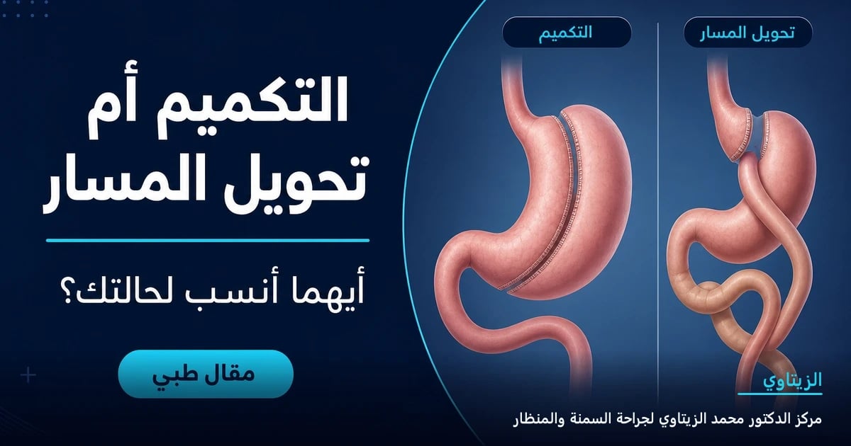 الفرق بين تكميم المعدة وتحويل المسار: أيهما أنسب لحالتك؟ — رسم توضيحي لمقال طبي | د. محمد عبد الوهاب الزيتاوي