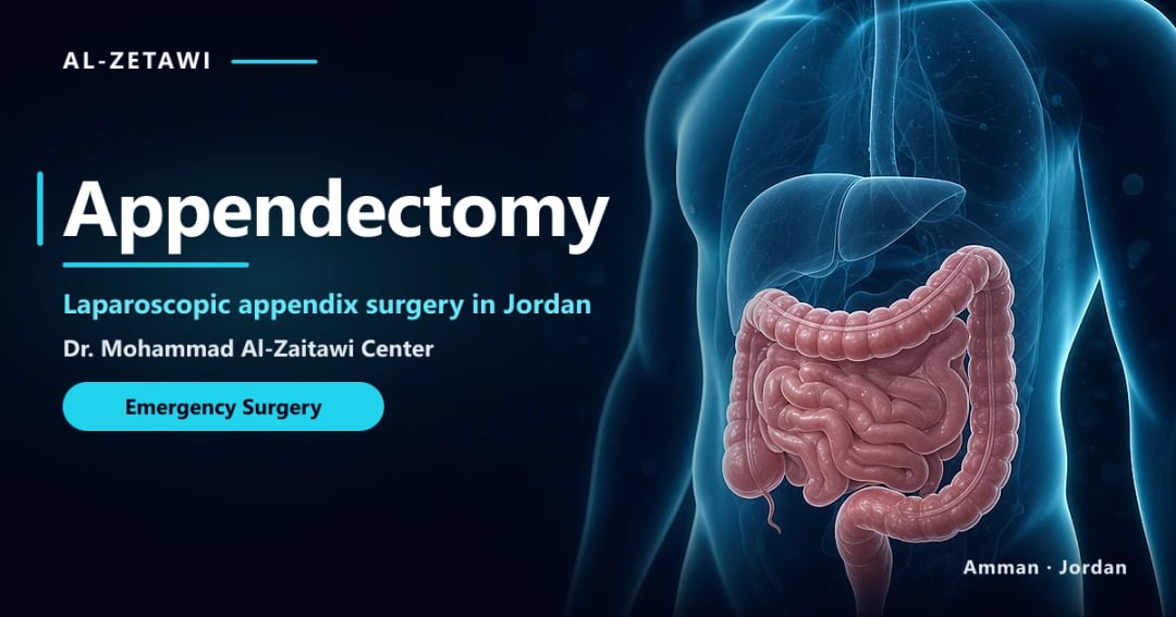 Appendectomy 3D illustration: the appendix on the large intestine, Jordan