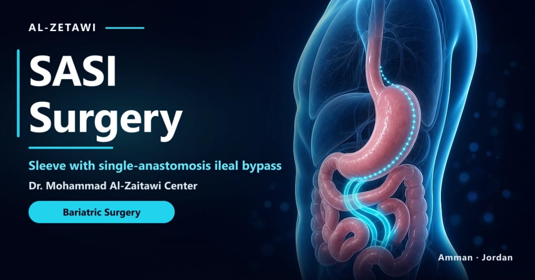 SASI Surgery in Jordan | Dr. Mohammad Al-Zaitawi SASI surgery 3D illustration: sleeve stomach with an added intestinal bypass creating two food pathways, Jordan