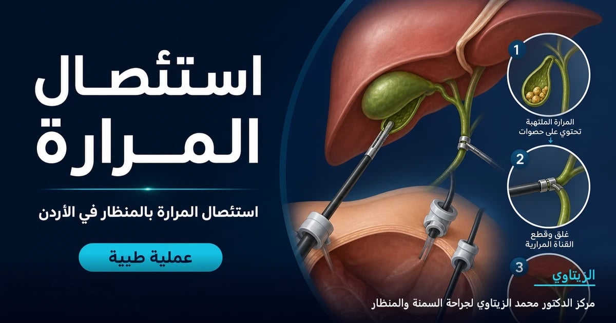 استئصال المرارة