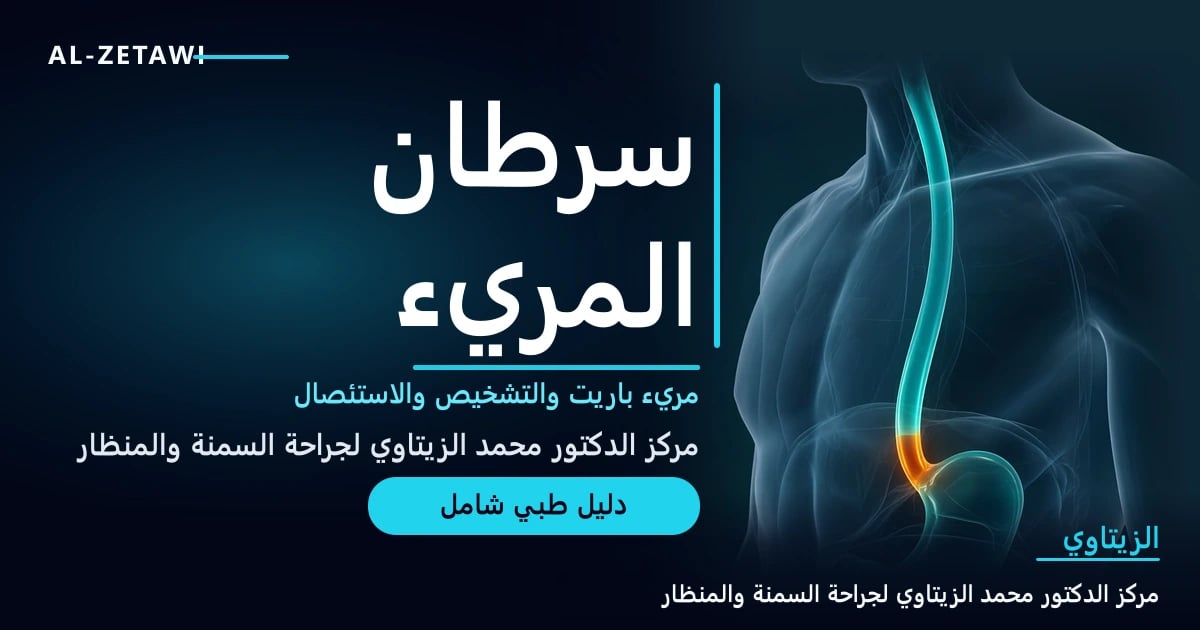 رسم طبي ثلاثي الأبعاد لمريء شفاف يمتد من الحلق إلى المعدة مع جزء متوهج متضيق قرب نهايته السفلية — سرطان المريء | د. محمد عبد الوهاب الزيتاوي