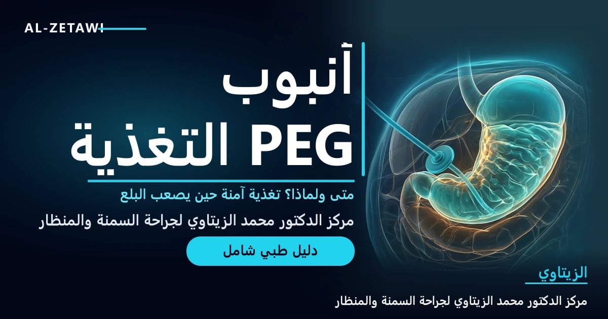 رسم طبي ثلاثي الأبعاد لمعدة شفافة بلون فيروزي مع أنبوب تغذية رفيع مرن يمر عبر جدار البطن إليها وقرص صغير مستدير عند الجلد — أنبوب التغذية PEG | د. محمد عبد الوهاب الزيتاوي