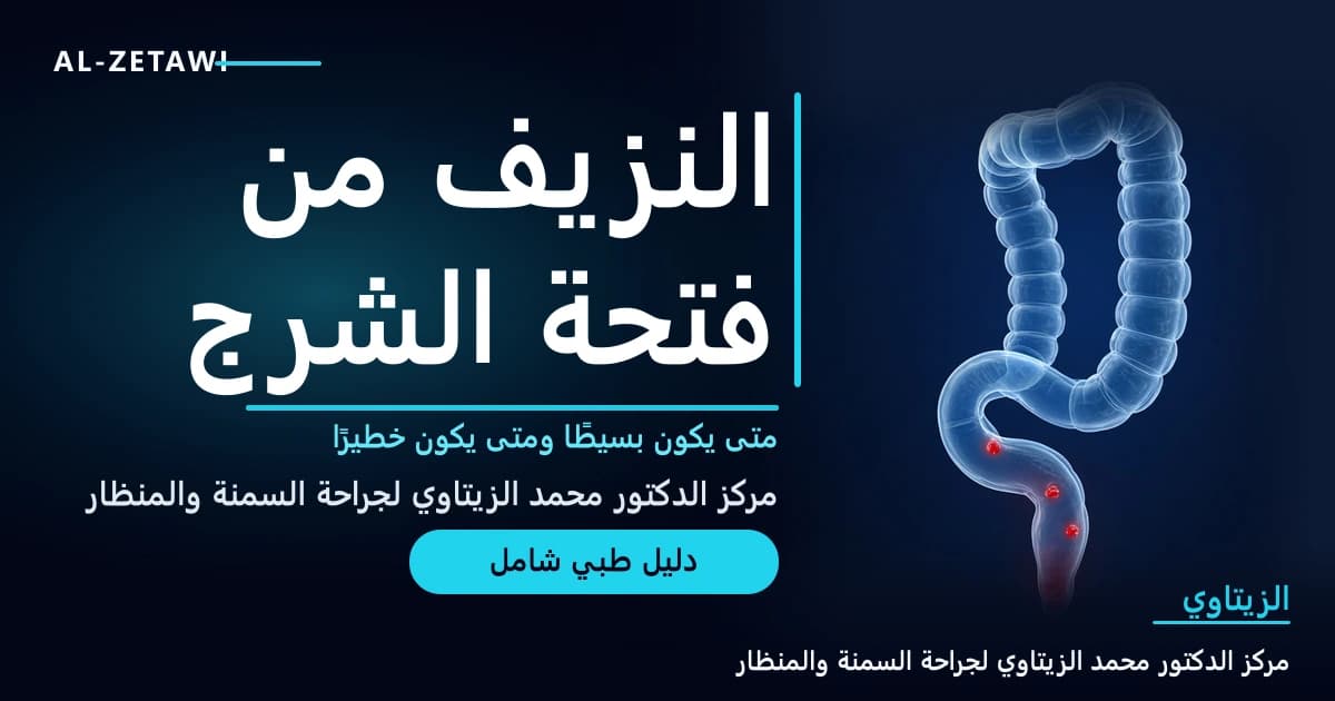 النزيف من فتحة الشرج: متى يكون بسيطًا ومتى يكون علامة على مرض خطير؟ | د. محمد عبد الوهاب الزيتاوي رسم طبي ثلاثي الأبعاد للقولون والمستقيم مع نقاط مضيئة باللون الأحمر تمثل مصادر النزيف — النزيف من فتحة الشرج | د. محمد عبد الوهاب الزيتاوي