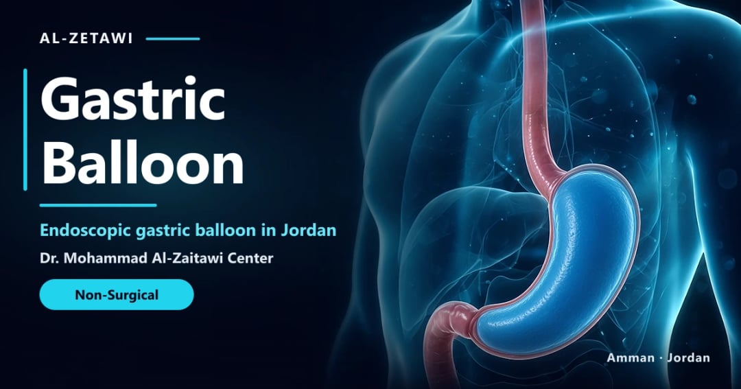 Gastric Balloon in Jordan | Dr. Mohammad Al-Zaitawi Gastric balloon 3D illustration: one fluid-filled balloon inside the stomach in Jordan
