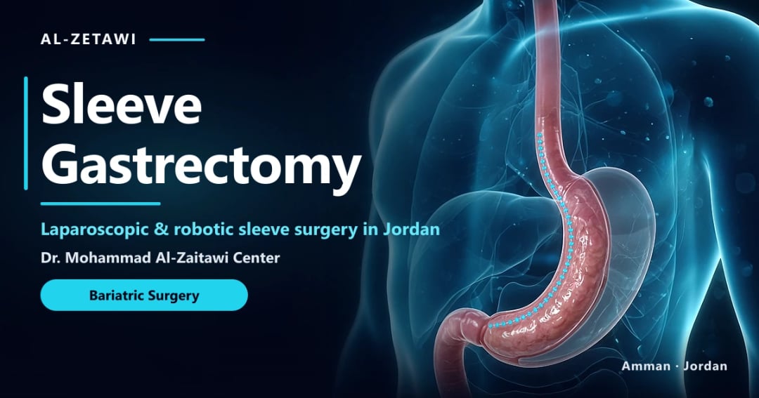 Sleeve Gastrectomy in Jordan | Dr. Mohammad Al-Zaitawi Sleeve gastrectomy 3D illustration: narrow sleeve stomach with staple line after weight loss surgery in Jordan