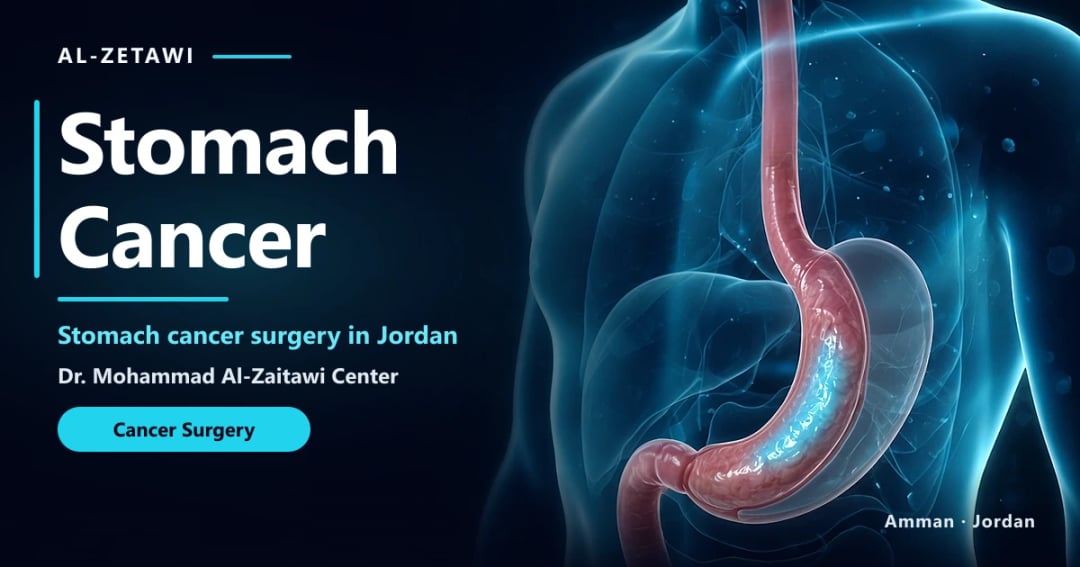 Stomach Cancer Surgery in Jordan | Dr. Mohammad Al-Zaitawi Stomach cancer 3D illustration: the stomach with a small highlighted area, patient guide in Jordan