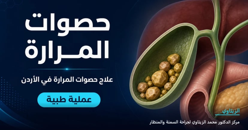 حصوات المرارة — رسم توضيحي للعملية في الأردن | د. محمد عبد الوهاب الزيتاوي