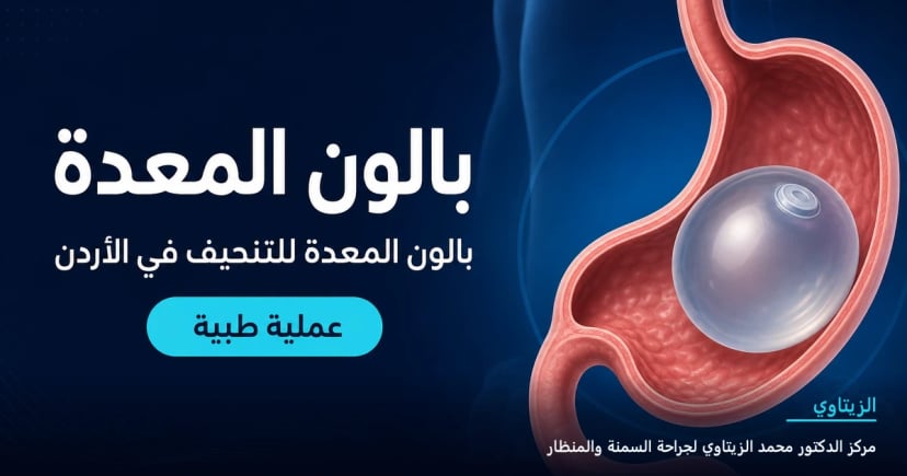 بالون المعدة — رسم توضيحي للعملية في الأردن | د. محمد عبد الوهاب الزيتاوي