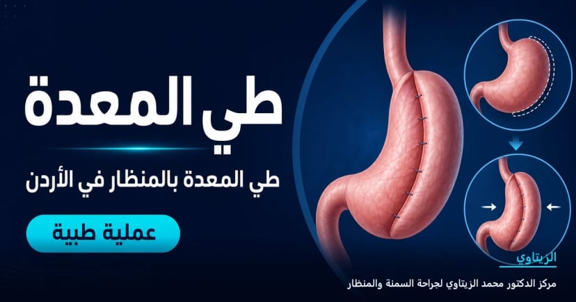 طي المعدة — رسم توضيحي للعملية في الأردن | د. محمد عبد الوهاب الزيتاوي