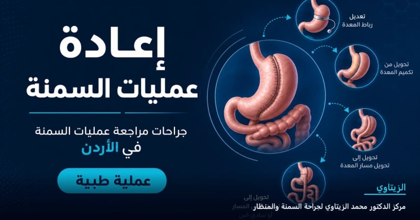 إعادة عمليات السمنة غير الناجحة — رسم توضيحي للعملية في الأردن | د. محمد عبد الوهاب الزيتاوي