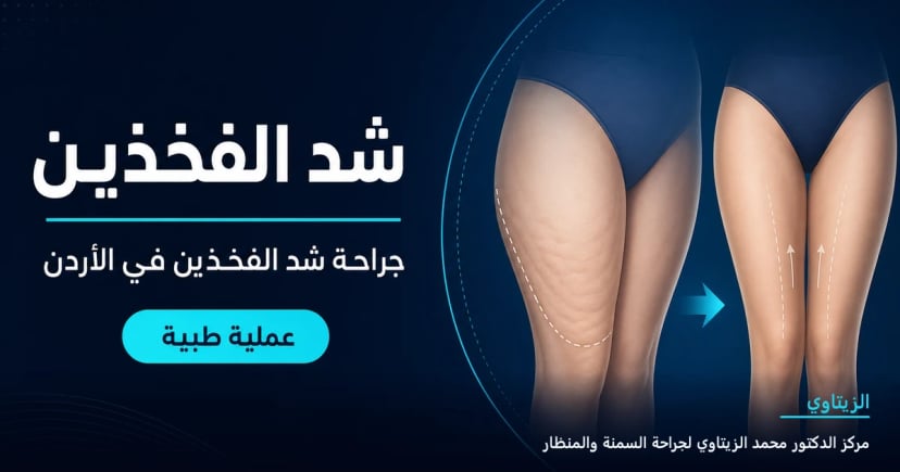 شد الفخذين — رسم توضيحي للعملية في الأردن | د. محمد عبد الوهاب الزيتاوي