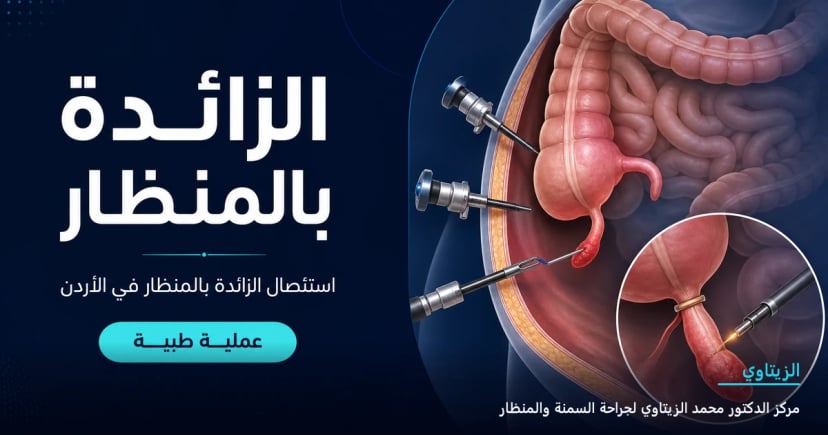 عملية الزائدة الدودية بالمنظار — رسم توضيحي في الأردن | د. محمد عبد الوهاب الزيتاوي