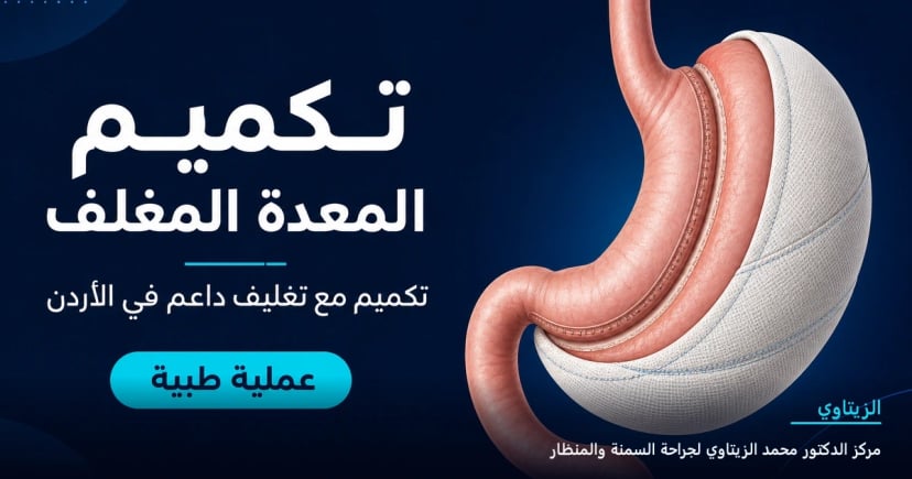 تكميم المعدة المغلف — رسم توضيحي للعملية في الأردن | د. محمد عبد الوهاب الزيتاوي