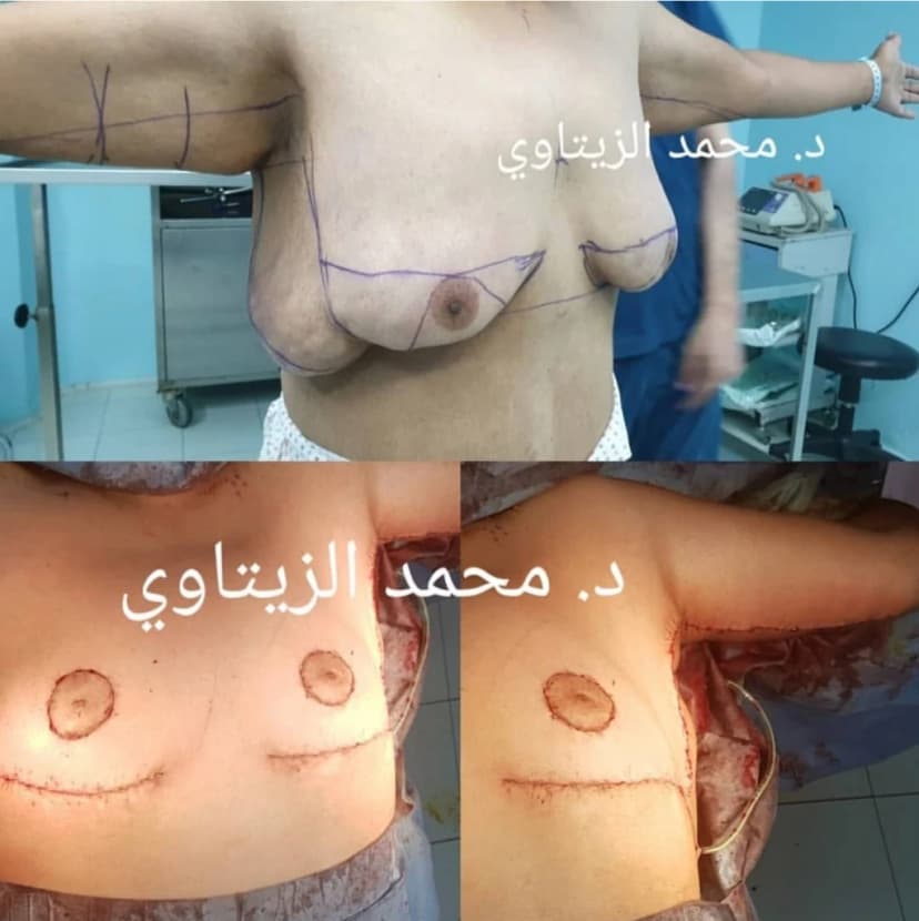 إزالة وشد ترهلات الصدر بعد تحويل المسار المصغر ونزول 70 كيلو | د. محمد عبد الوهاب الزيتاوي صورة قبل وبعد عملية إزالة وشد ترهلات الصدر لمريض بعد تحويل المسار المصغر ونزول أكثر من 70 كيلو — د. محمد عبد الوهاب الزيتاوي في الأردن
