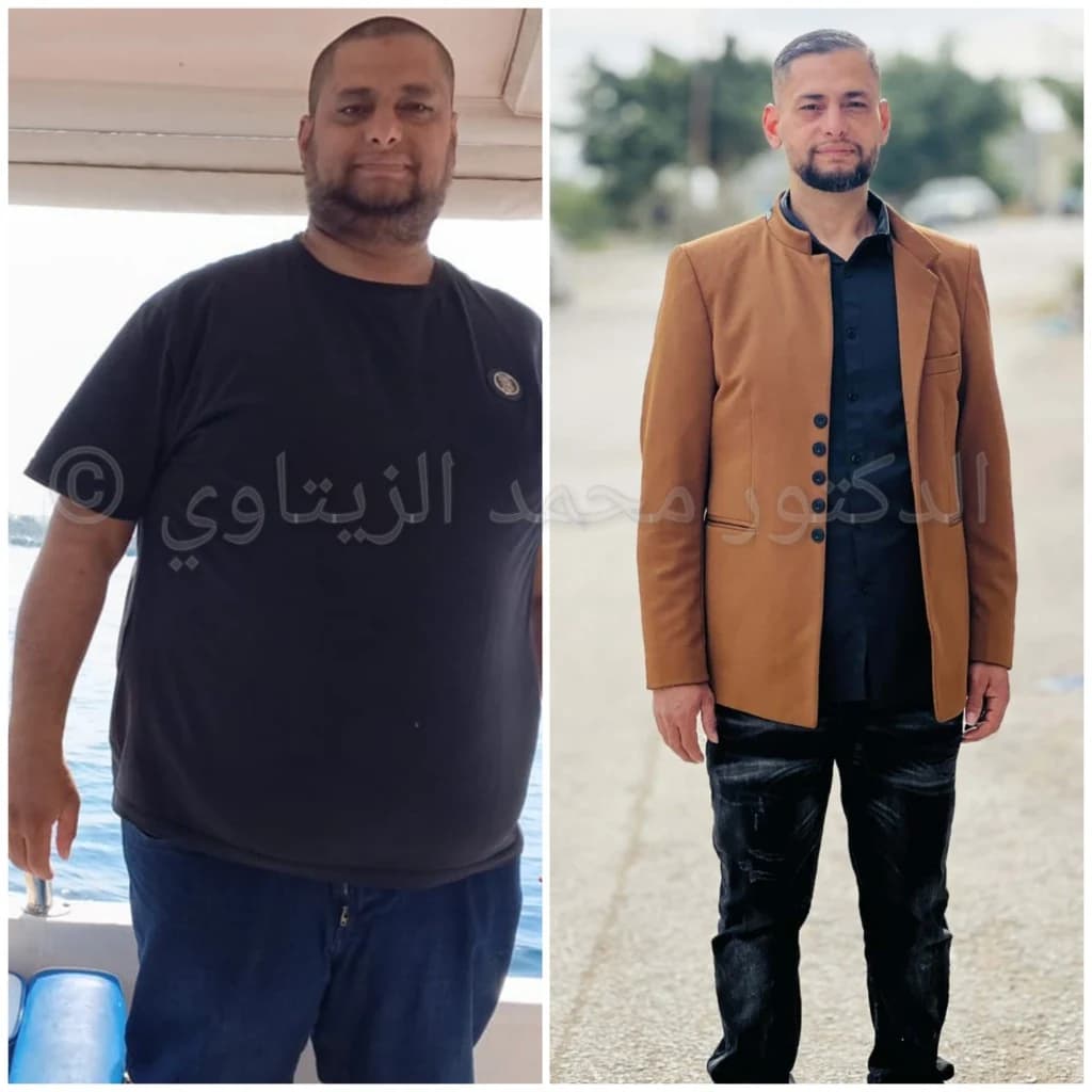 Kanaan before and after mini gastric bypass, second photo: 59 kg lighter | Dr. Al-Zaitawi Second before and after photo of Kanaan from Palestine: 59 kg lost after mini gastric bypass with Dr. Mohammad Al-Zaitawi