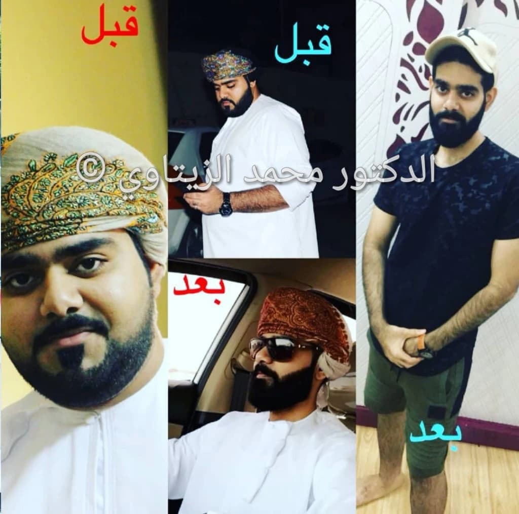 نتيجة تحويل المسار المصغر: نزول 52 كيلو خلال أقل من 6 أشهر | د. محمد عبد الوهاب الزيتاوي صورة قبل وبعد عملية تحويل المسار المصغر للمريض سعيد من سلطنة عمان: من 119 إلى 67 كيلو خلال أقل من 6 أشهر — مركز الدكتور محمد عبد الوهاب الزيتاوي
