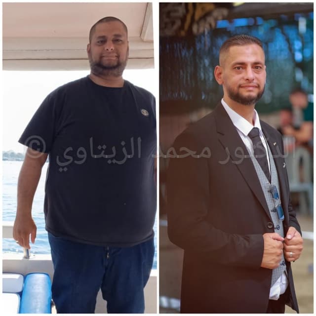 صورة قبل وبعد تحويل المسار المصغر لكنعان من فلسطين: من 140 كيلو إلى 81 كيلو، وما زال وزنه ثابتاً بعد 3 سنوات من العملية — مركز الدكتور محمد عبد الوهاب الزيتاوي