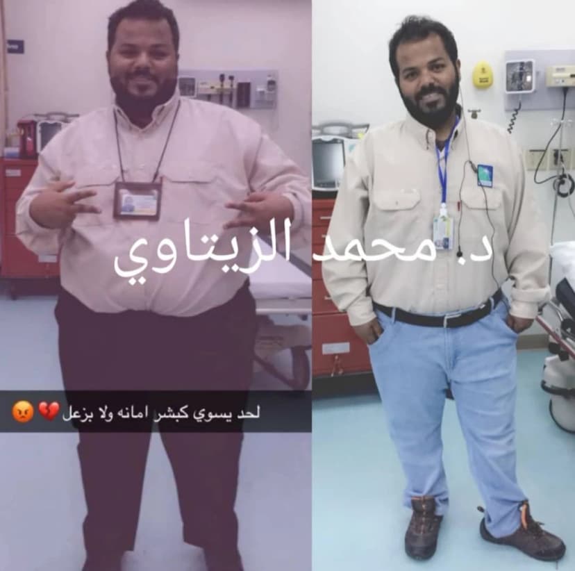 نتيجة تحويل المسار المصغر لمدمني الحلويات والمشروبات الغازية: نزول 55 كيلو | د. محمد عبد الوهاب الزيتاوي صورة قبل وبعد عملية تحويل المسار المصغر لمحمد من السعودية: من 140 إلى 85 كيلو — مركز الدكتور محمد عبد الوهاب الزيتاوي