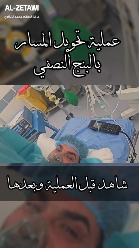 عملية تحويل المسار المصغر بالبنج النصفي: المريض مستيقظ | د. محمد عبد الوهاب الزيتاوي مريض مستيقظ يتنفس بقناع الأكسجين على طاولة العمليات أثناء تحويل المسار المصغر بالبنج النصفي — مركز الدكتور محمد عبد الوهاب الزيتاوي