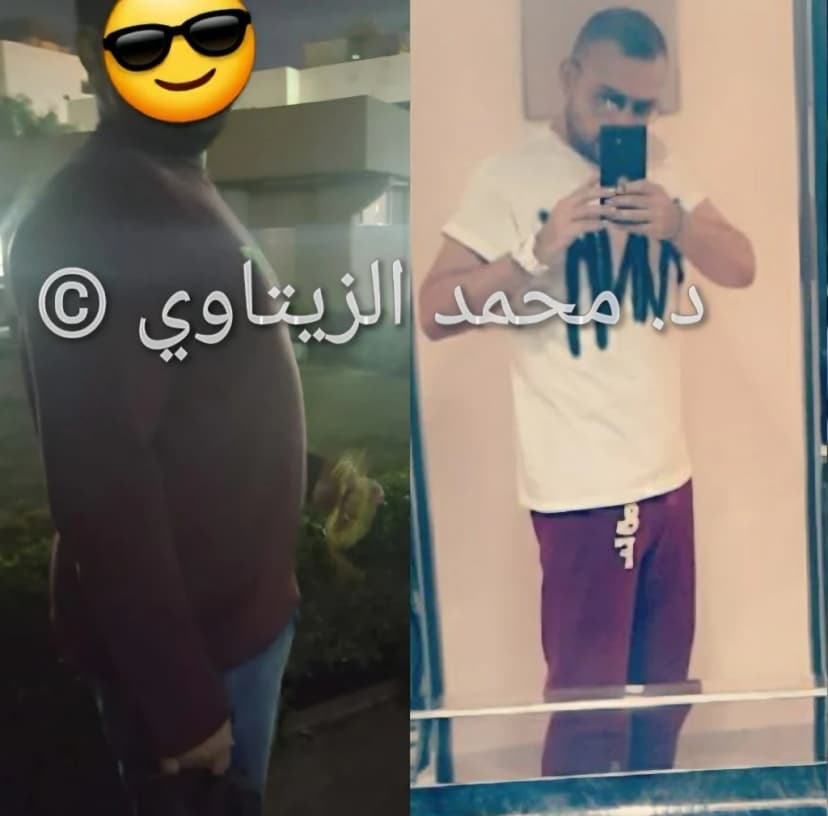 نتيجة تكميم المعدة: نزول 25 كيلو بعد 6 أشهر دون ترهلات أو آثار للعملية | د. محمد عبد الوهاب الزيتاوي صورة قبل وبعد عملية تكميم المعدة للمريض علي من الكويت: من 100 إلى 75 كيلو بعد 6 أشهر — مركز الدكتور محمد عبد الوهاب الزيتاوي