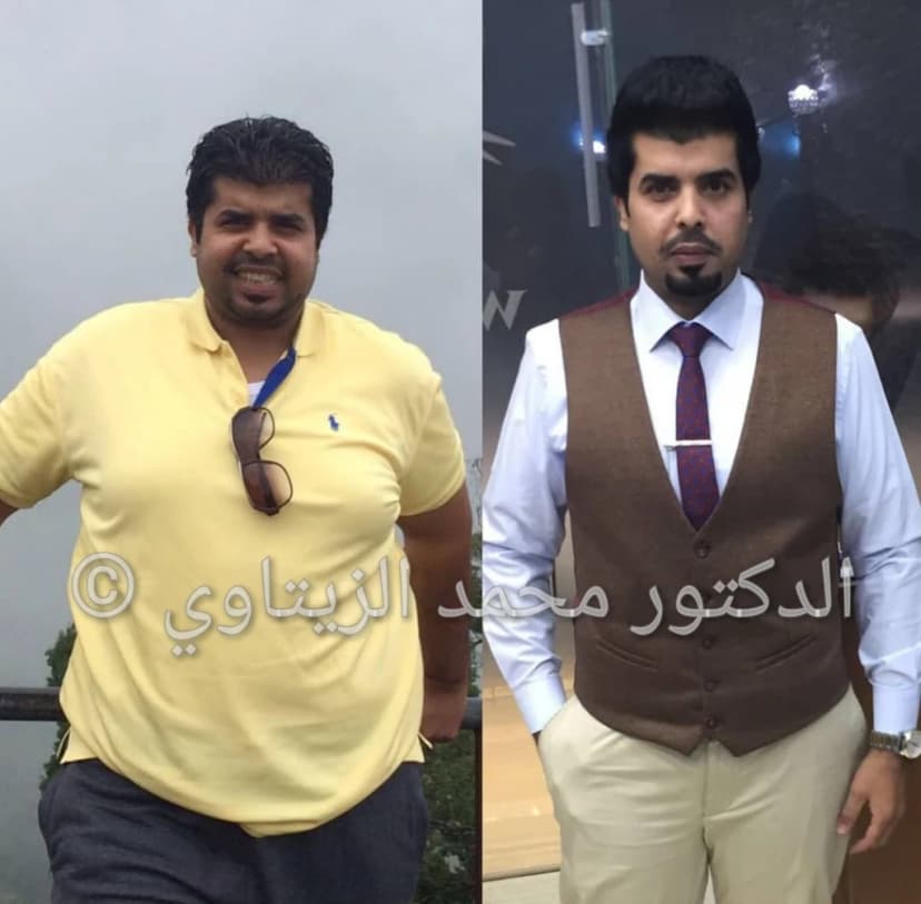 نتيجة تكميم المعدة: نزول 48 كيلو بعد 10 شهور وتحسن آلام المفاصل والركب | د. محمد عبد الوهاب الزيتاوي صورة قبل وبعد عملية تكميم المعدة للمريض ماجد الرسلاني من السعودية: من 128 إلى 80 كيلو بعد 10 شهور — مركز الدكتور محمد عبد الوهاب الزيتاوي