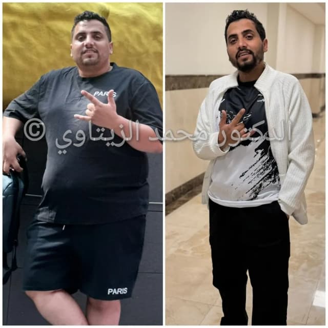 صورة قبل وبعد عملية تكميم المعدة للمريض إبراهيم العنسي من اليمن: نزول من 131 إلى 86 كيلو خلال 6 شهور — مركز الدكتور محمد عبد الوهاب الزيتاوي