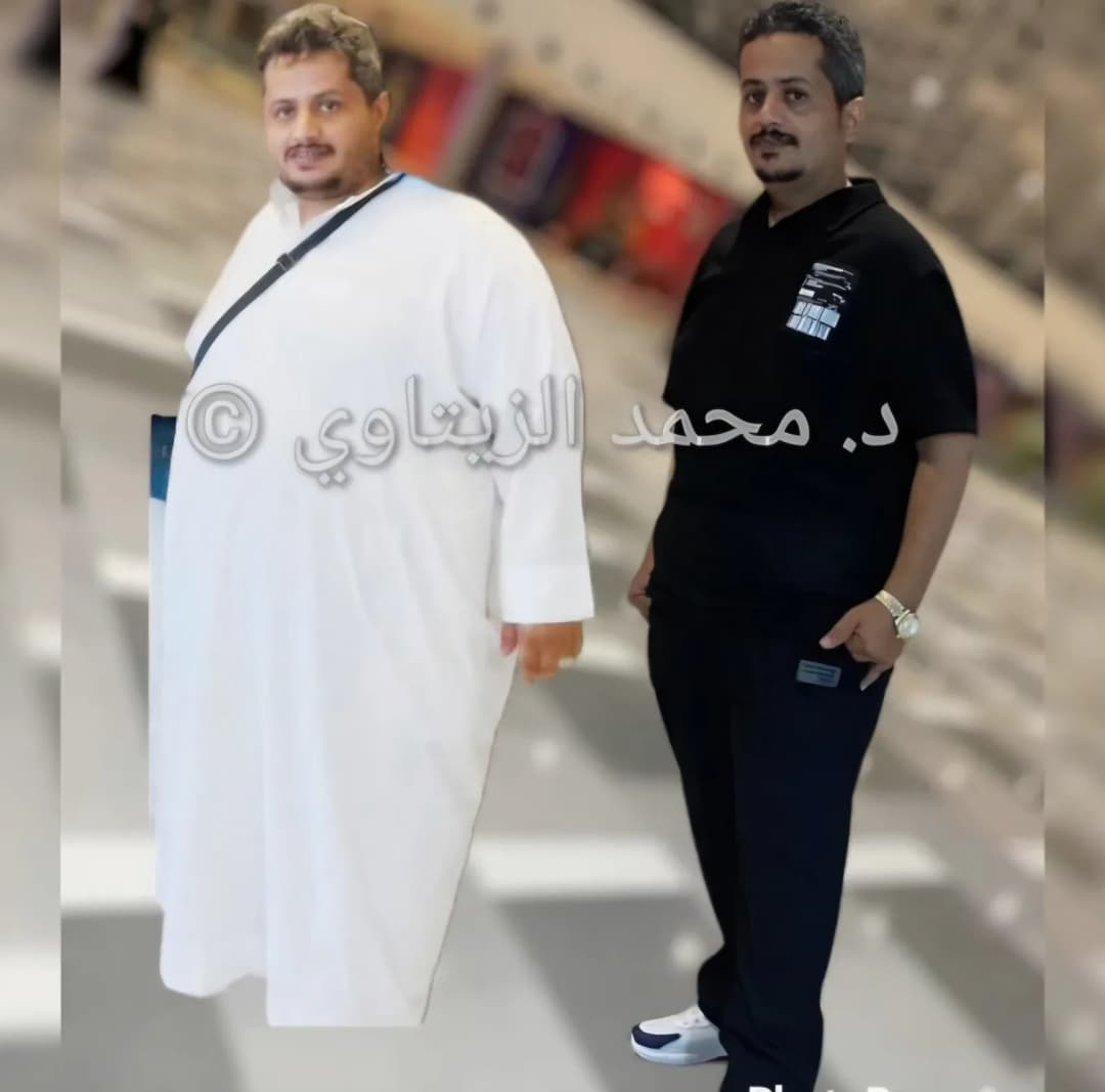 معاذ محمد من السعودية قبل وبعد تكميم المعدة: نزول 55 كيلو (من 135 إلى 80) | د. محمد عبد الوهاب الزيتاوي صورة قبل وبعد عملية تكميم المعدة للمريض معاذ محمد من السعودية: من 135 إلى 80 كيلو بعد فشل الكيتو والصيام المتقطع — مركز الدكتور محمد عبد الوهاب الزيتاوي