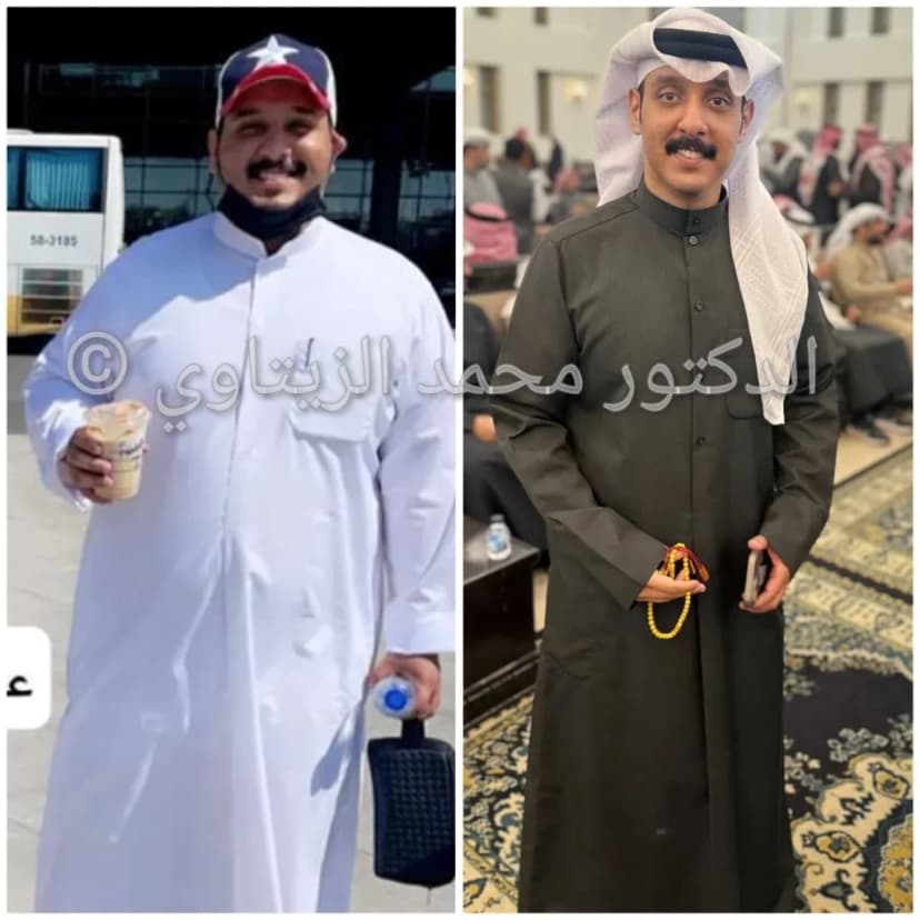 أحمد الظفيري من الكويت قبل وبعد تكميم المعدة: نزول 57 كيلو خلال سنة | د. محمد عبد الوهاب الزيتاوي صورة قبل وبعد عملية تكميم المعدة للمريض أحمد الظفيري من الكويت: من 140 إلى 83 كيلو ومقاس الملابس من 3XL إلى L — مركز الدكتور محمد عبد الوهاب الزيتاوي