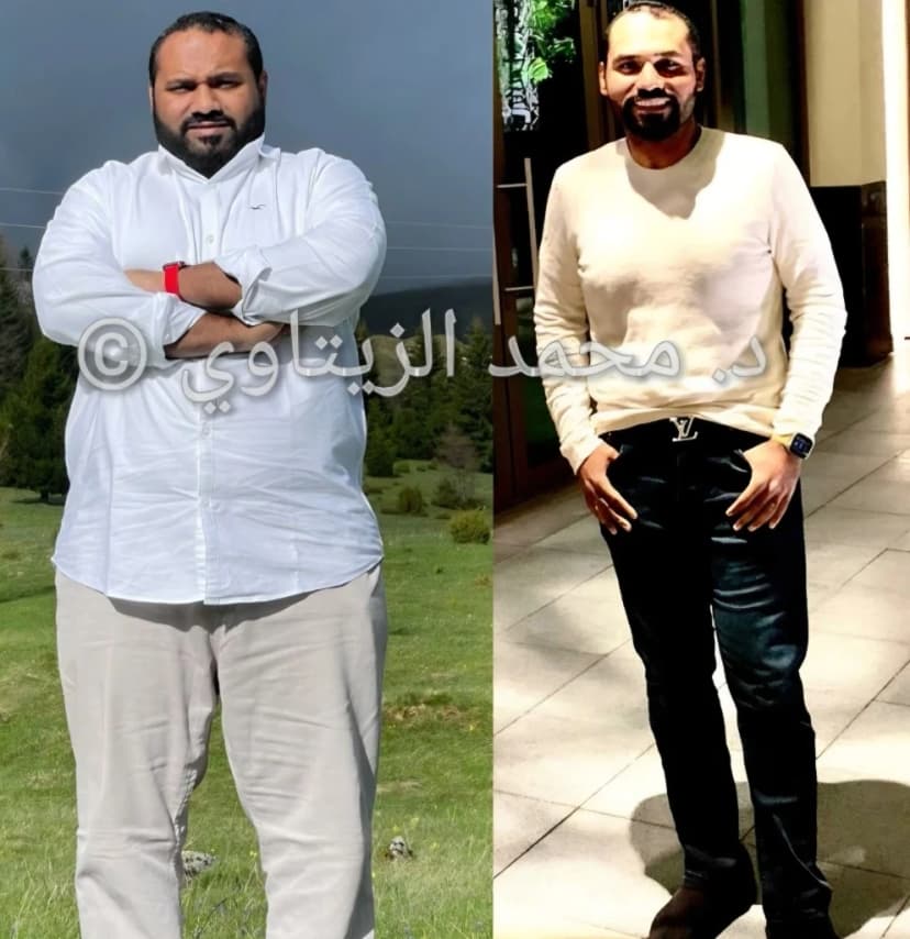 نتيجة تكميم المعدة: نزول 55 كيلو خلال 10 شهور بعد تشخيص بداية السكري | د. محمد عبد الوهاب الزيتاوي صورة قبل وبعد عملية تكميم المعدة للمريض محمد جاسم من البحرين: من 140 إلى 85 كيلو خلال 10 شهور — مركز الدكتور محمد عبد الوهاب الزيتاوي