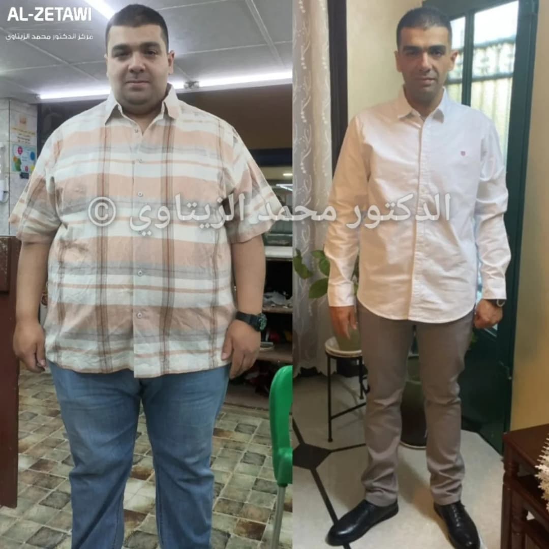 نتيجة تكميم المعدة: نزول 75 كيلو خلال سنة ونصف | د. محمد عبد الوهاب الزيتاوي صورة قبل وبعد عملية تكميم المعدة للمريض عبد الرحمن حشحوش من الأردن: نزول من 145 إلى 70 كيلو — مركز الدكتور محمد عبد الوهاب الزيتاوي