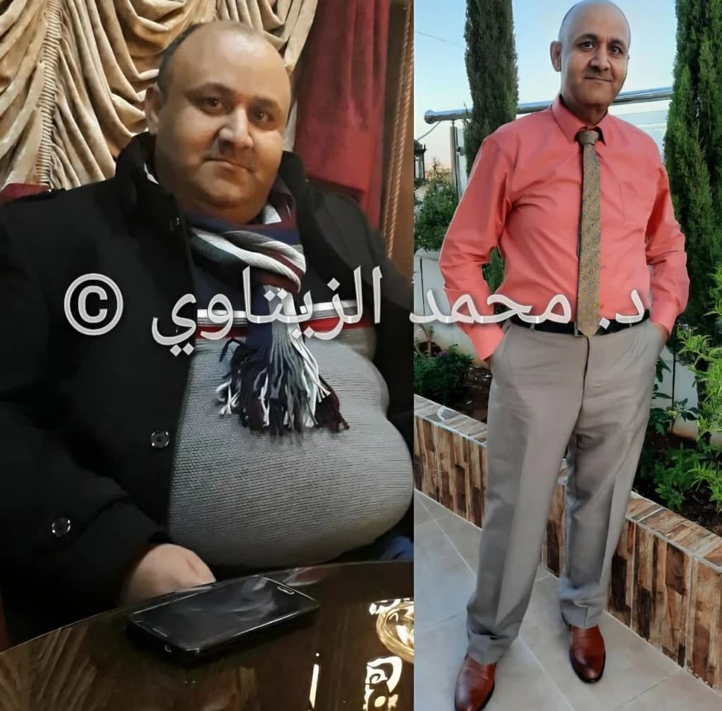 نتيجة تكميم المعدة بعد عامين: من 147 إلى 84 كيلو بعمر 45 سنة دون عمليات شد | د. محمد عبد الوهاب الزيتاوي صورة قبل وبعد عملية تكميم المعدة لخلدون مساعدة من الأردن: من 147 إلى 84 كيلو بعد عامين دون عمليات شد — مركز الدكتور محمد عبد الوهاب الزيتاوي