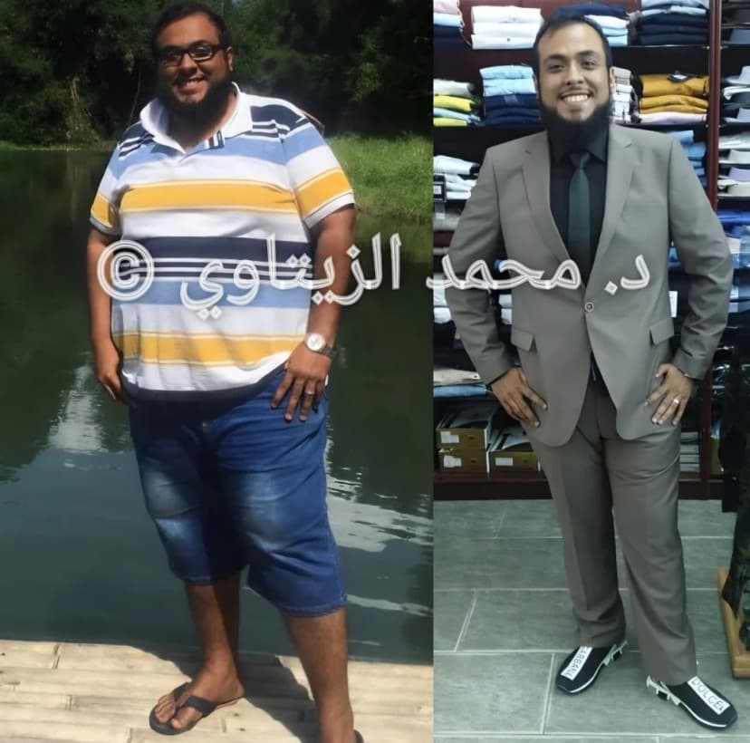 نتيجة تكميم المعدة بعد سنة: محمد باجندوح نزل 63 كيلو (من 150 إلى 87) | د. محمد عبد الوهاب الزيتاوي صورة قبل وبعد عملية تكميم المعدة لمحمد باجندوح من السعودية: من 150 إلى 87 كيلو بعد سنة من العملية — مركز الدكتور محمد عبد الوهاب الزيتاوي