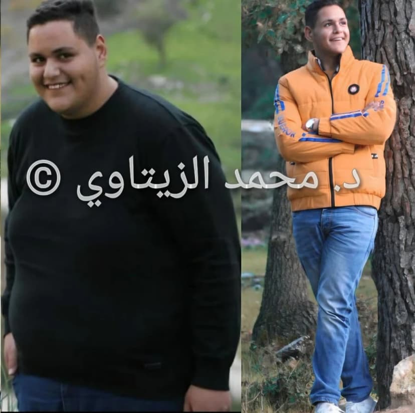 نتيجة تكميم المعدة لشاب بعمر 20 سنة: من 156 إلى 80 كيلو خلال 10 أشهر | د. محمد عبد الوهاب الزيتاوي صورة قبل وبعد عملية تكميم المعدة للشاب بهاء الدين الزغل من الأردن بعمر 20 سنة: من 156 إلى 80 كيلو خلال 10 أشهر — مركز الدكتور محمد عبد الوهاب الزيتاوي