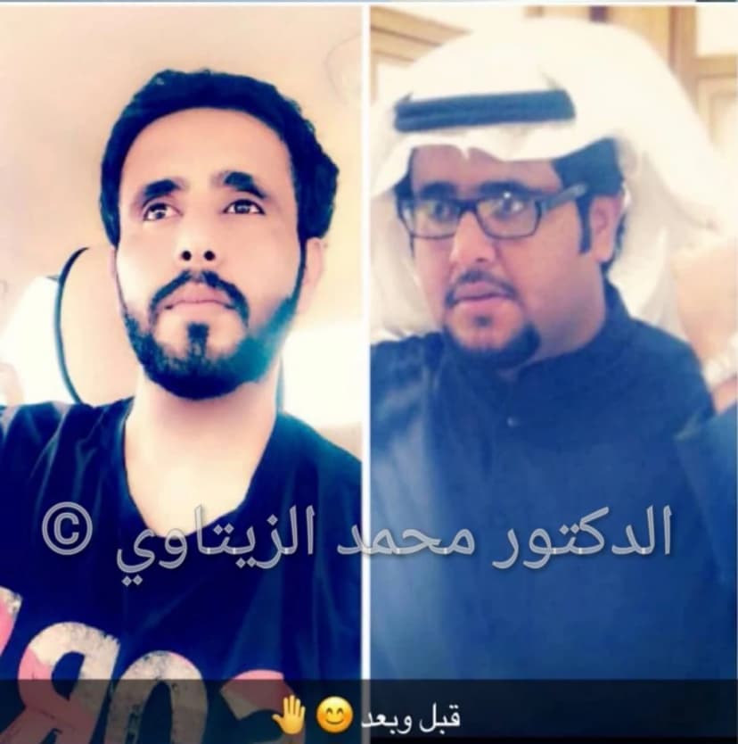 نتيجة تكميم المعدة: نزول 73 كيلو خلال أقل من 6 أشهر دون ترهلات في البطن | د. محمد عبد الوهاب الزيتاوي صورة قبل وبعد عملية تكميم المعدة للمريض حسين اليامي من السعودية: من 174 إلى 101 كيلو خلال أقل من 6 أشهر — مركز الدكتور محمد عبد الوهاب الزيتاوي